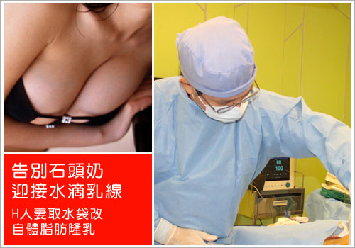 東區辣媽告別石頭奶-取水袋改自體脂肪隆乳手術記