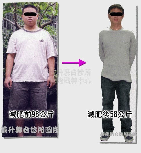 减肥治疗前体重98公斤减肥治疗后体重58公斤