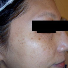 净肤雷射黑斑、雀斑、发炎后色素沉淀治疗前