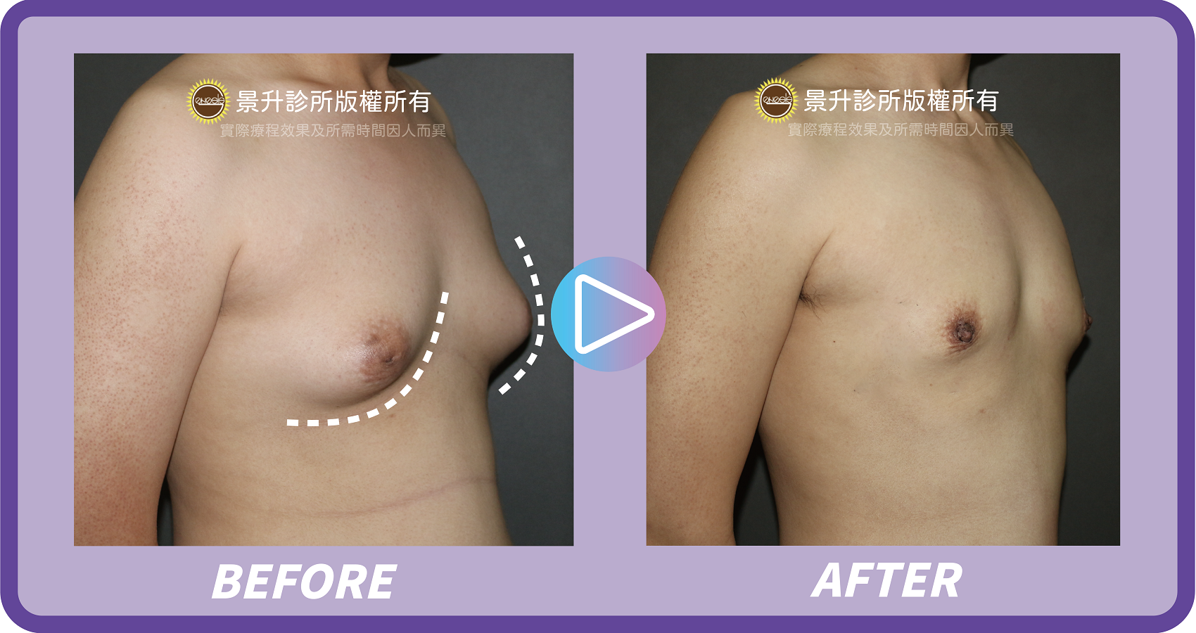 男性女乳手術 打造自信胸膛 景升診所22