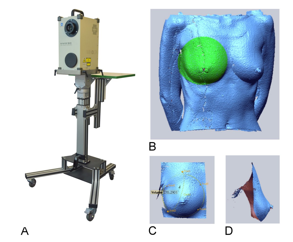 3-D 雷射掃描計算乳房體積是非常準確的乳房體積評估法