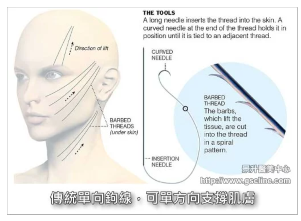 埋線拉提緊實肌膚：微創不須漫長恢復期