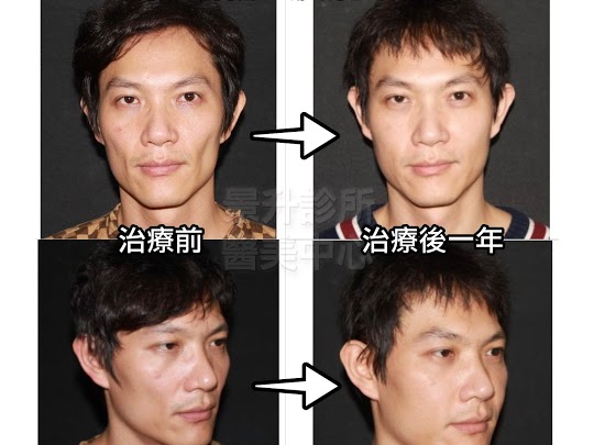 自體脂肪填補, 效果明顯且持久