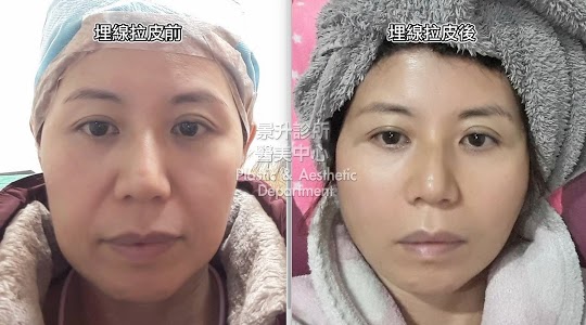 埋線拉皮是改善臉部下垂最有效的方法