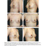 景升診所 自體脂肪論文 連續七年刊登國際期刊 Autologous Fat Grafting for Breast Augmentation in Underweight Women Aesthetic Surgery Journal 2014 Chiu 1090820X14540679 頁面 07 2024 最新指南