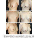 景升診所 自體脂肪論文 連續七年刊登國際期刊 Autologous Fat Grafting for Breast Augmentation in Underweight Women Aesthetic Surgery Journal 2014 Chiu 1090820X14540679 頁面 10 2024 最新指南