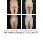 景升診所 自體脂肪論文 連續七年刊登國際期刊 Autologous Fat Grafting for Breast Augmentation in Underweight Women Aesthetic Surgery Journal 2014 Chiu 1090820X14540679 頁面 11 2024 最新指南