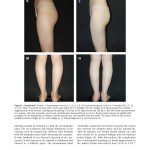 Autologous Fat Grafting for Breast Augmentation in Underweight Women