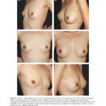 景升診所 自體脂肪論文 連續七年刊登國際期刊 Autologous Fat Grafting for Breast Augmentation in Underweight Women Aesthetic Surgery Journal 2014 Chiu 1090820X14540679 頁面 15 2024 最新指南