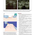 景升診所 自體脂肪論文 連續七年刊登國際期刊 Autologous Fat Grafting for Breast Augmentation in Underweight Women Aesthetic Surgery Journal 2014 Chiu 1090820X14540679 頁面 17 2024 最新指南