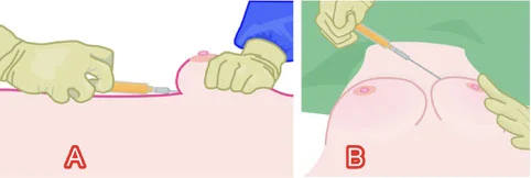 隆乳豐胸最佳選擇:自體脂肪隆乳 84 隆乳、自體豐胸示意圖