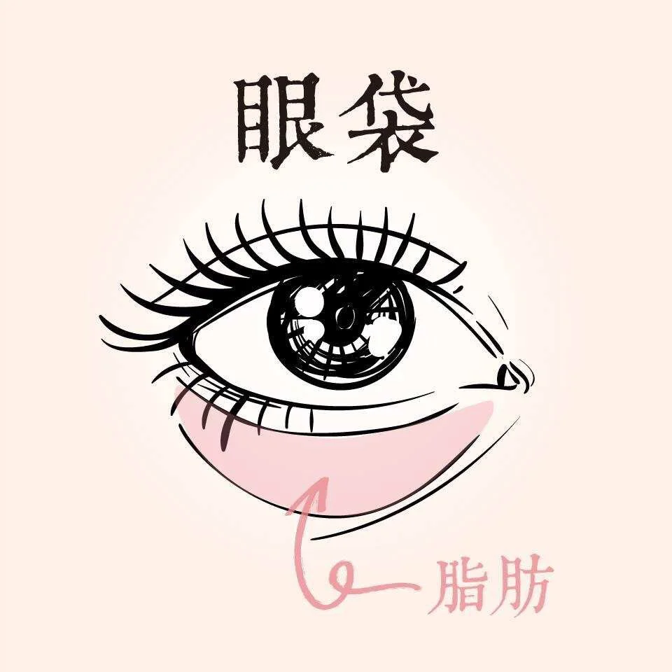眼袋-不動手術的眼袋去除法 8 眼袋是下眼臉下方因為脂肪下垂膨出形成的袋狀組織