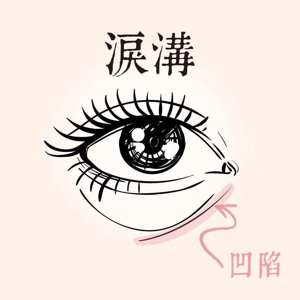 眼袋-不動手術的眼袋去除法 10 有些人會因為淚溝凹陷而使眼袋特別明顯
