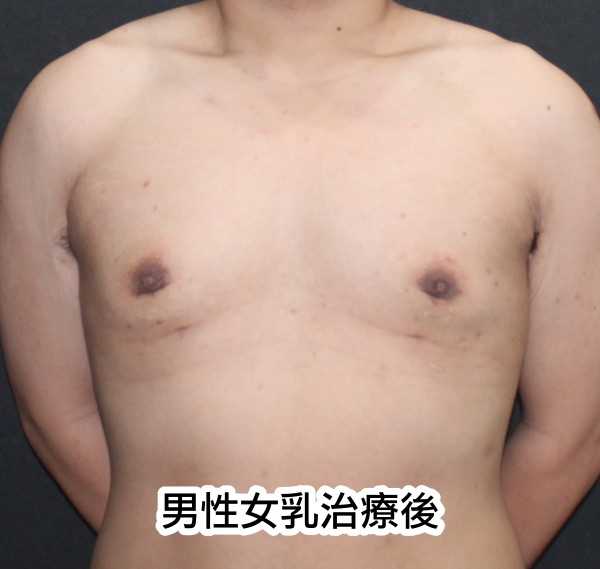 男性女乳治療後