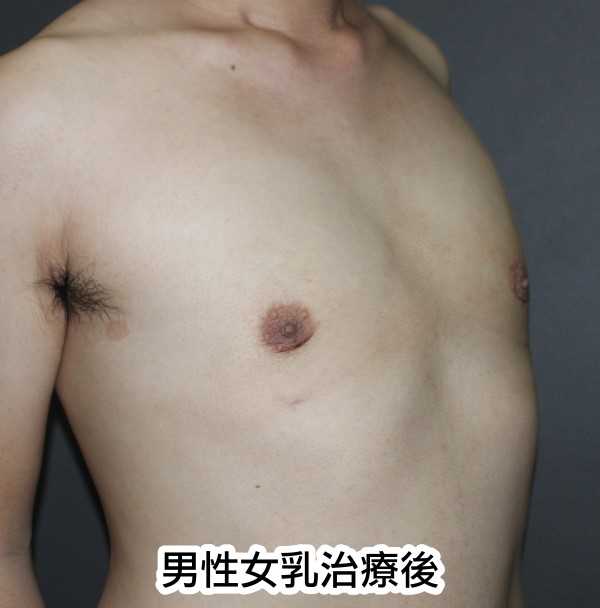 男性女乳治療後