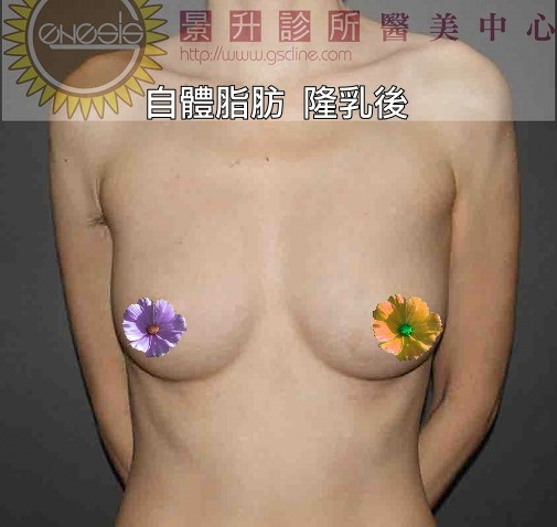 極受女性自體脂肪隆乳後