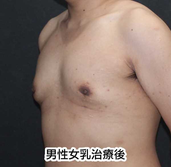 男性女乳治療後