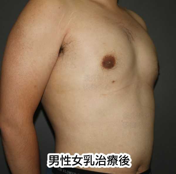 男性女乳治療後側面