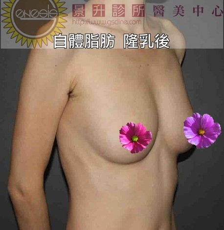 極瘦女性自體隆乳後