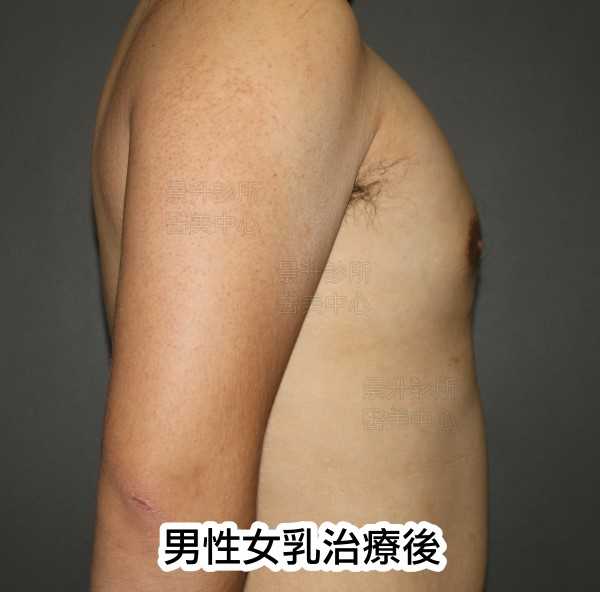 男性女乳治療後正側面