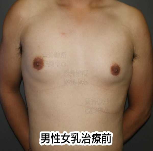 男性女乳治療前正面