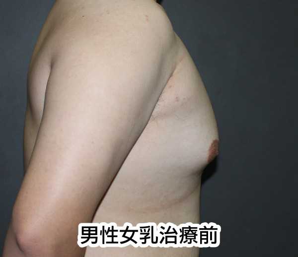 男性女乳治療前正側面