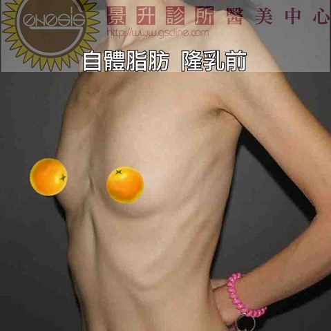 極瘦女性自體隆乳前