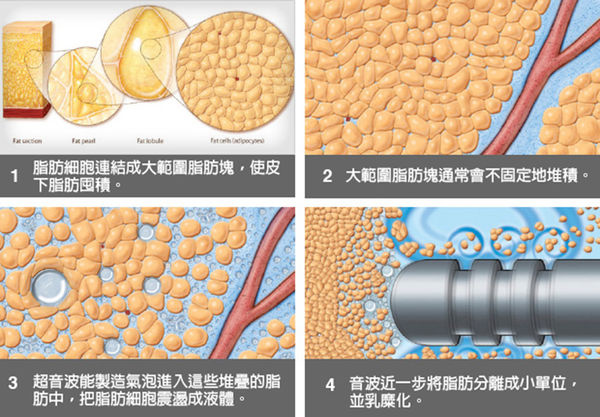 超音波溶脂的脂肪可以做自體脂肪隆乳,這是醫學文獻證實的事