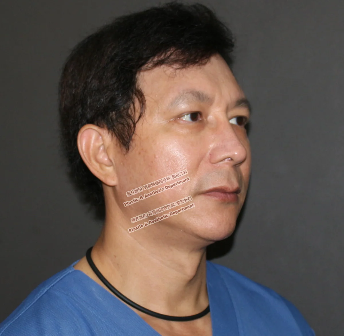 眼袋-不動手術的眼袋去除法 12 眼袋不動手術治療後