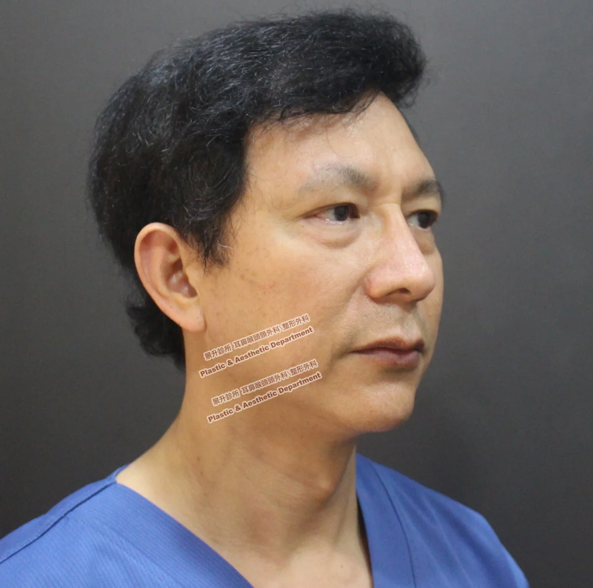 眼袋-不動手術的眼袋去除法 11 眼袋不動手術治療前