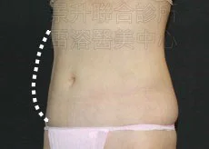 溶脂瘦小腹後