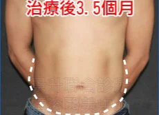溶脂瘦小腹後