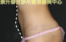 溶脂瘦小腹後