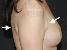 溶脂消除副乳前