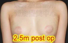 溶脂消除副乳後