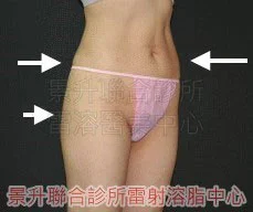 溶脂瘦小腹後