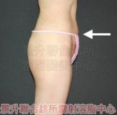 溶脂瘦腰後