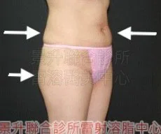 溶脂瘦小腹前