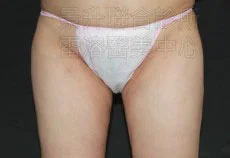 溶脂瘦腿後