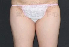 溶脂瘦腿前