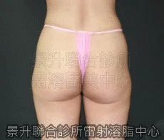 溶脂瘦腿後