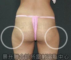 溶脂瘦腿前