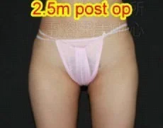 溶脂瘦腿後