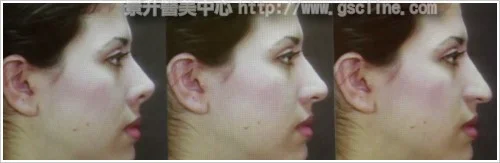 ▲中間的圖片是側面看起來完美的鼻形和臉型，水微晶可調整鼻型和下巴