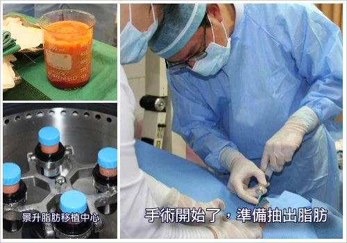 隆乳豐胸最佳選擇:自體脂肪隆乳 57 隆乳_自體脂肪隆乳手術圖