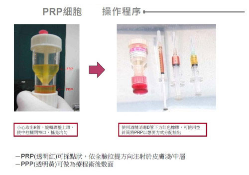 Prp血漿生長因子 景升診所
