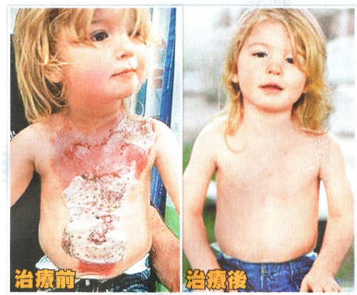 皮膚遭燙傷，經由PRP和自體皮膚細胞培養的組織治療後神奇的復原