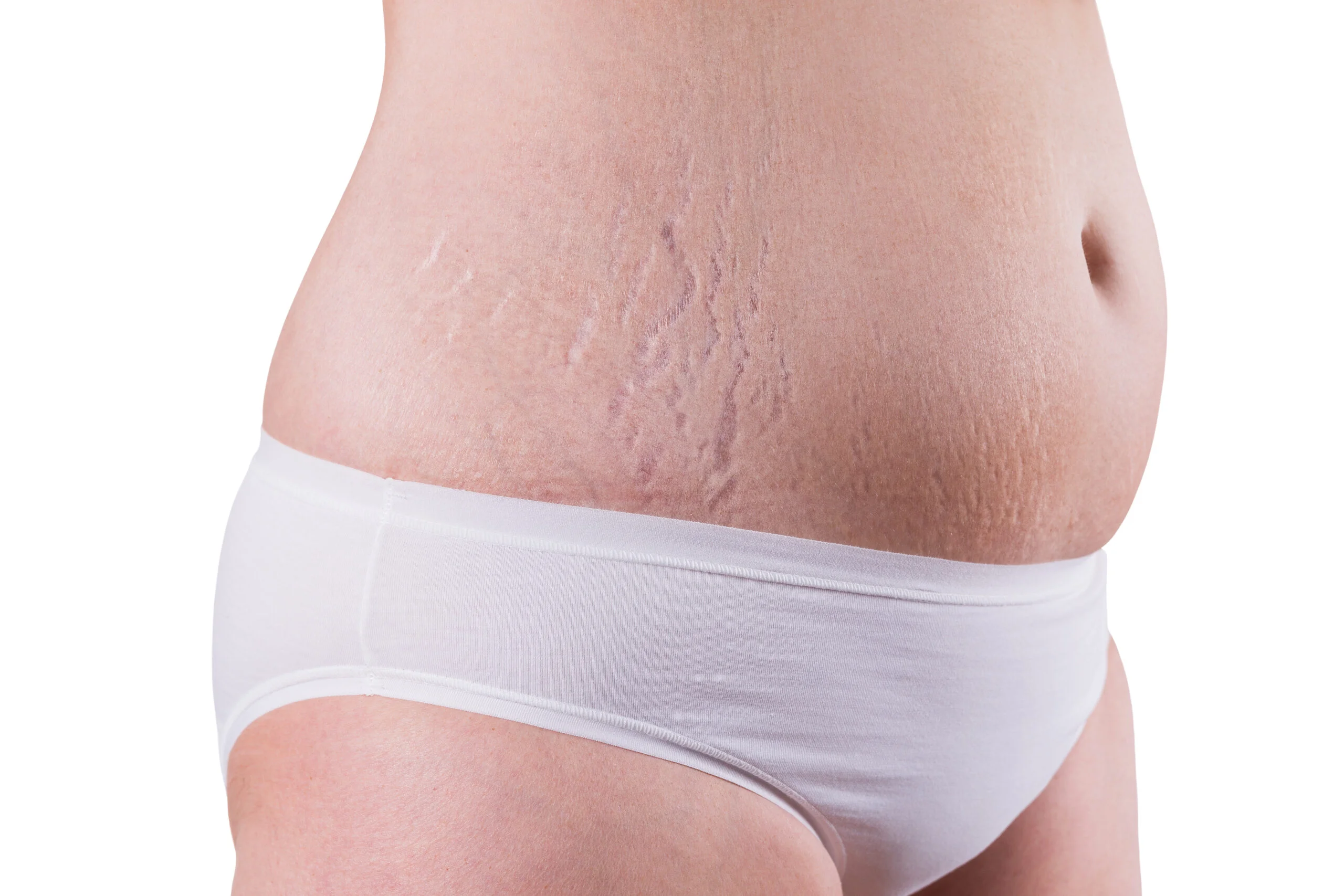 光纖雷射輔助抽脂如何改善妊娠紋？