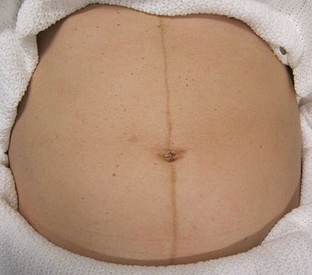妊娠線是腹部中央的色素線