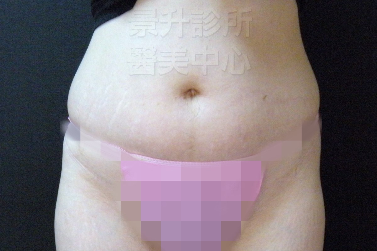 妊娠紋治療後